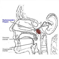 Adenoide Vegetationen (Polypen)